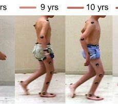 EE Bulter, KM Steele, L Torburn, JG Gamble, J Rose (2016) “Clinical motion analyses over eight consecutive years in a child with crouch gait: a case report.” Journal of Medical Case Reports