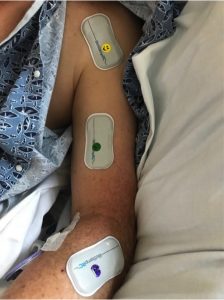 Three biostamp monitors on the arm of a patient in the hospital after a stroke.
