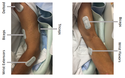 Left image depicts arm with pads placed over muscle with right pictures depicting similar image